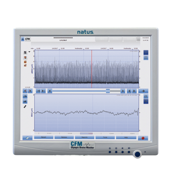 ELECTROENCEFALOGRAFIA AMPLIADA OBM - EEGa